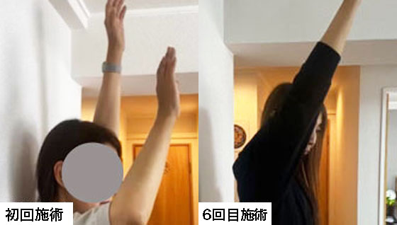 肩意改善の結果